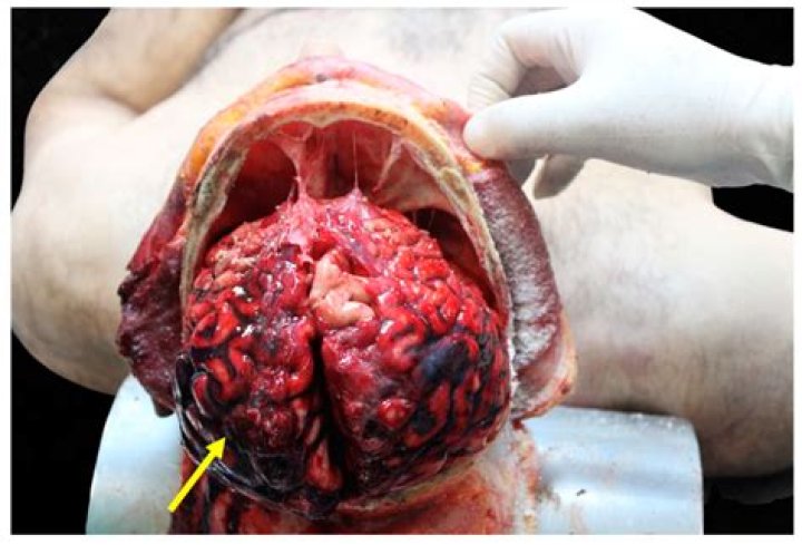 Unraveling The Mystery Of Tarrare's Stomach Inside